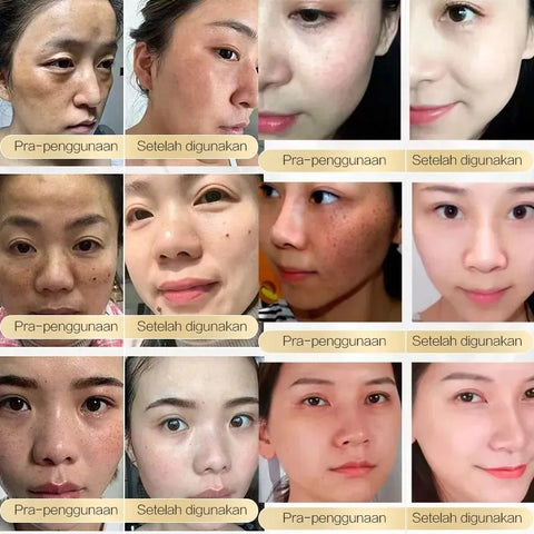 CHALONESE Brightening Cream Serum 20g – Skin Brightening & Dark Spot Correcting Cream
